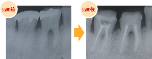 歯内療法　ケース1