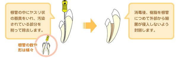 ���ǂ̒��Ƀ��X����̊�������A��������Ă��镔��������ď������܂��B���Ō�A���������ǂɂ߂ĊO������׋ۂ��N�����Ȃ��悤�������܂��B